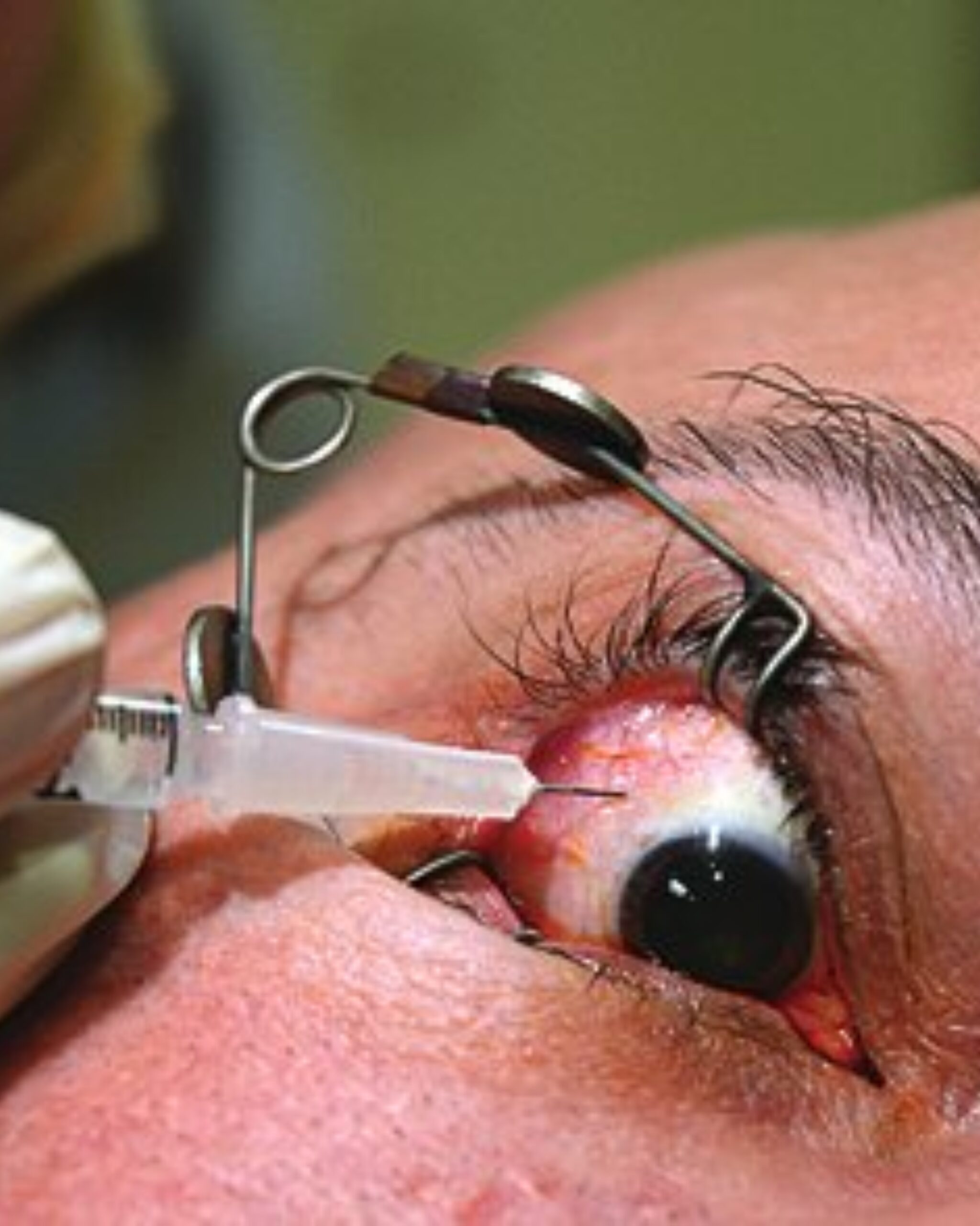 INTRAVITREAL INJECTIONS