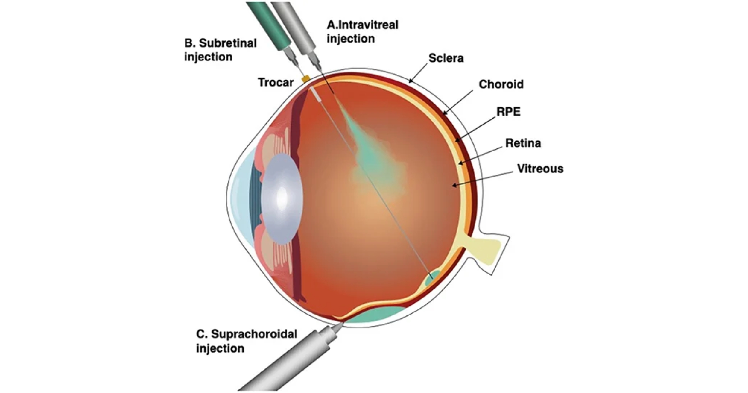 Intravitreal Injection Treatment In Mumbai