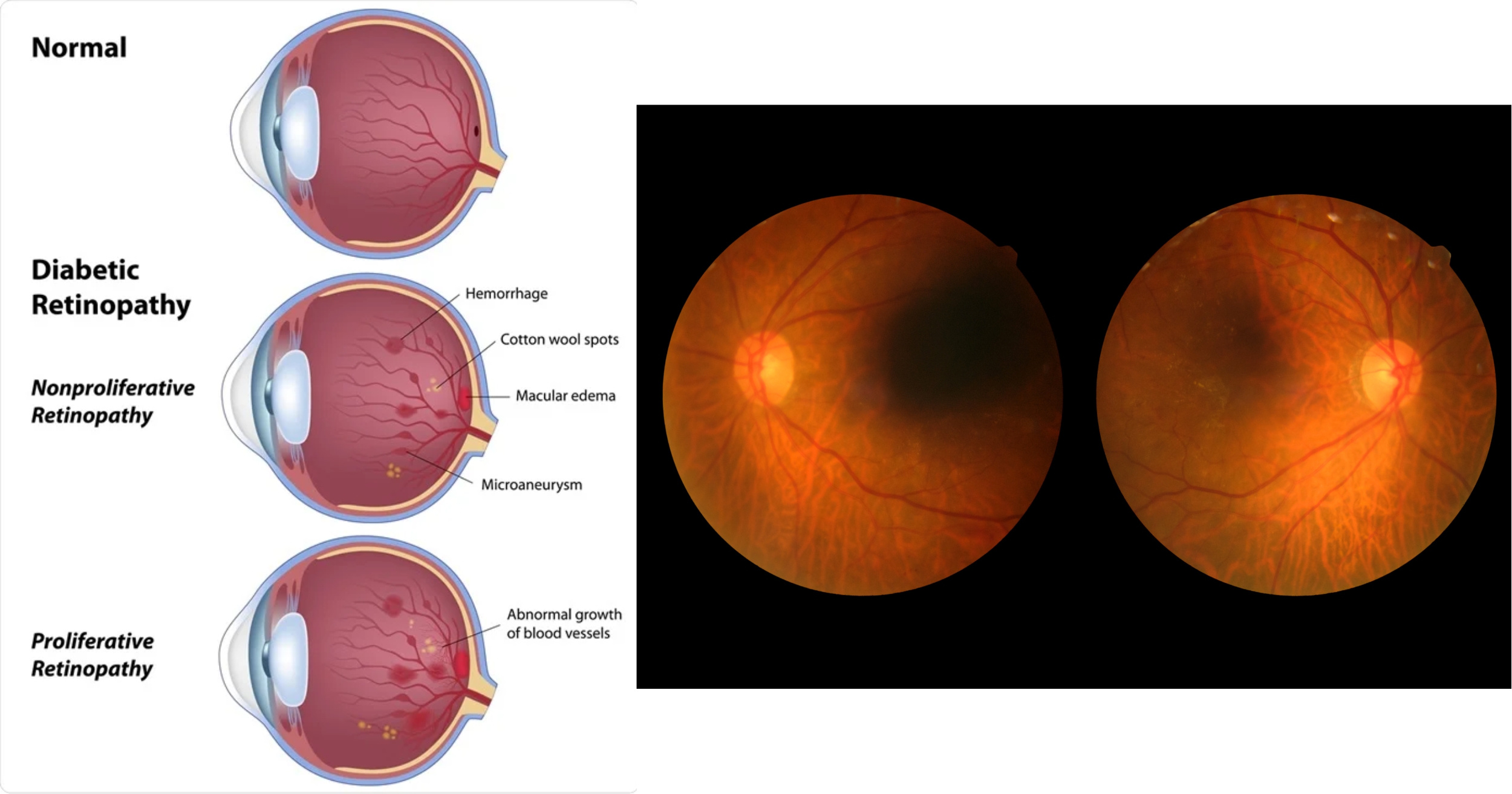 Diabetic Retinopathy surgery in mumbai