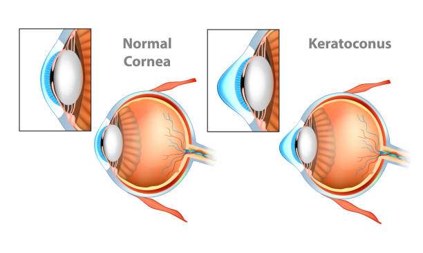 keratoconus surgery in mumbai